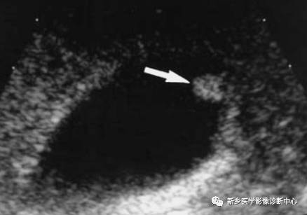 深度学习:13种胆囊炎性病变 深度学习:13种胆囊炎性病变