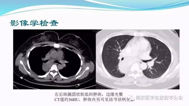 【病例】后纵隔Castleman病1例CT影像表现