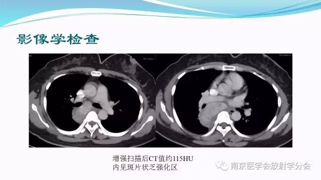 【病例】后纵隔Castleman病1例CT影像表现
