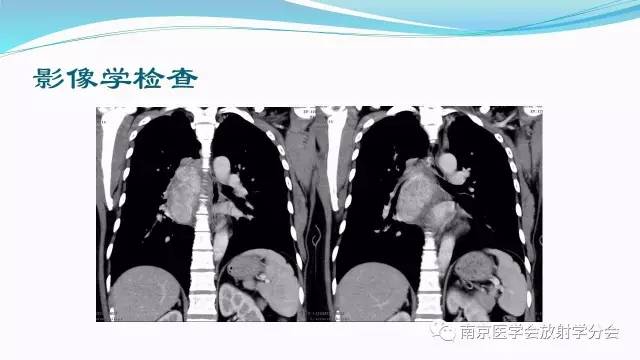 【病例】后纵隔Castleman病1例CT影像表现