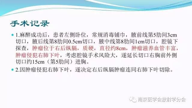 【病例】后纵隔Castleman病1例CT影像表现