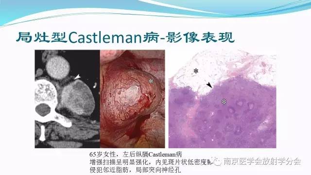 【病例】后纵隔Castleman病1例CT影像表现