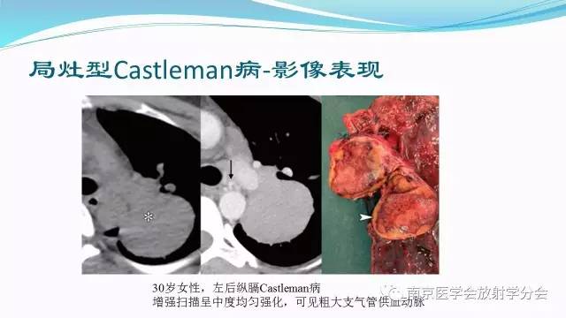 【病例】后纵隔Castleman病1例CT影像表现