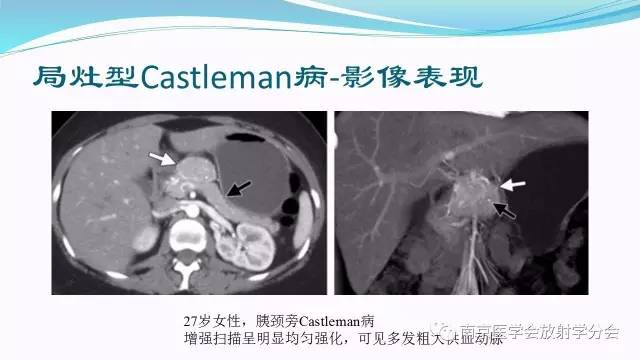 【病例】后纵隔Castleman病1例CT影像表现