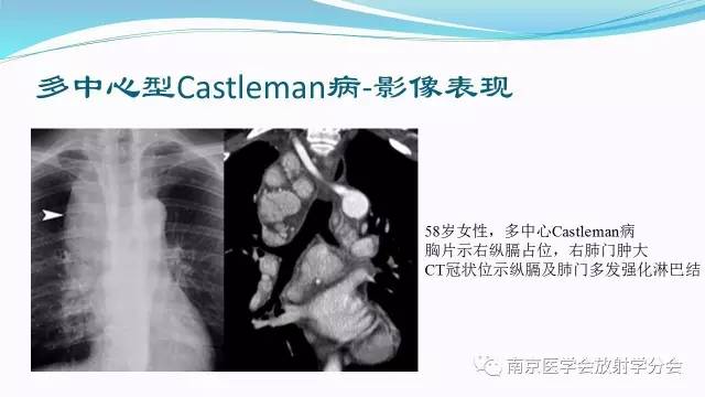 【病例】后纵隔Castleman病1例CT影像表现