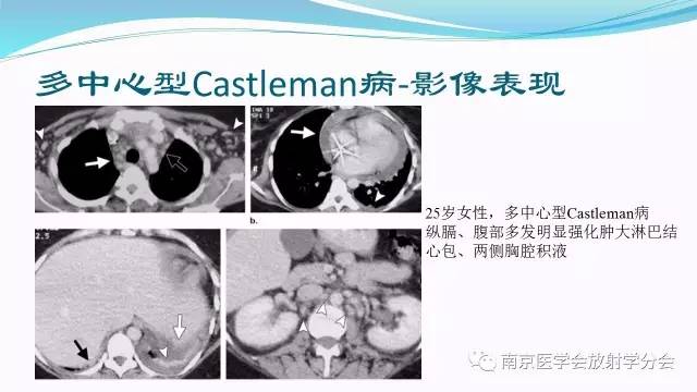 【病例】后纵隔Castleman病1例CT影像表现