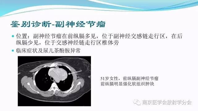 【病例】后纵隔Castleman病1例CT影像表现