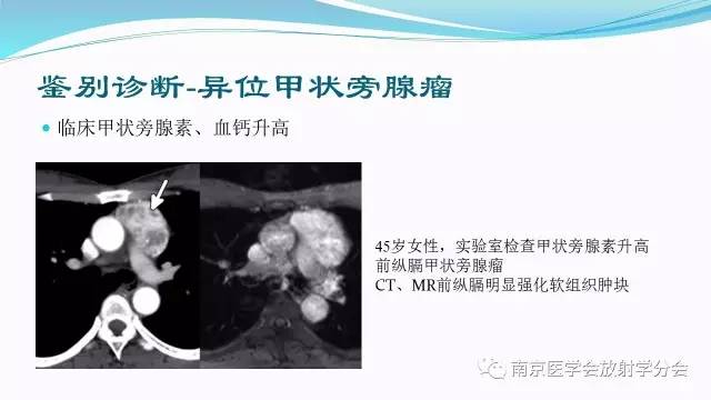 【病例】后纵隔Castleman病1例CT影像表现