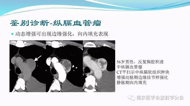 【病例】后纵隔Castleman病1例CT影像表现