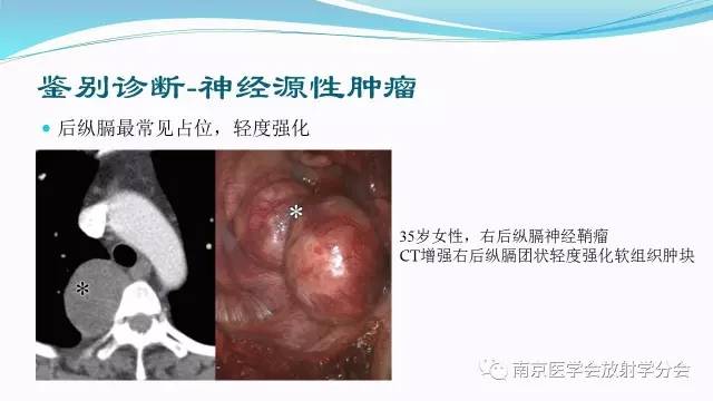 【病例】后纵隔Castleman病1例CT影像表现