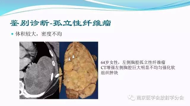 【病例】后纵隔Castleman病1例CT影像表现