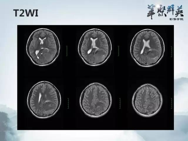 【病例】颅内孤立性纤维瘤1例MR影像表现与鉴别