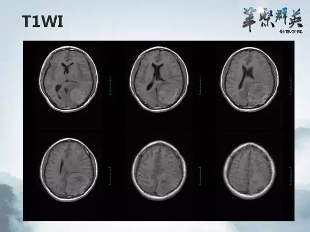 【病例】颅内孤立性纤维瘤1例MR影像表现与鉴别