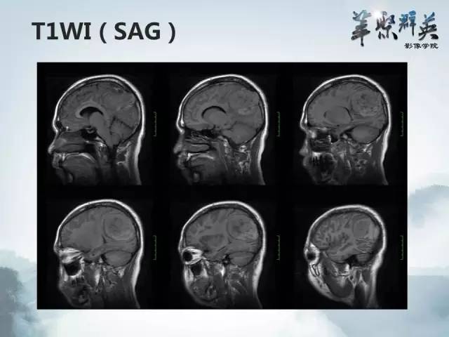 【病例】颅内孤立性纤维瘤1例MR影像表现与鉴别
