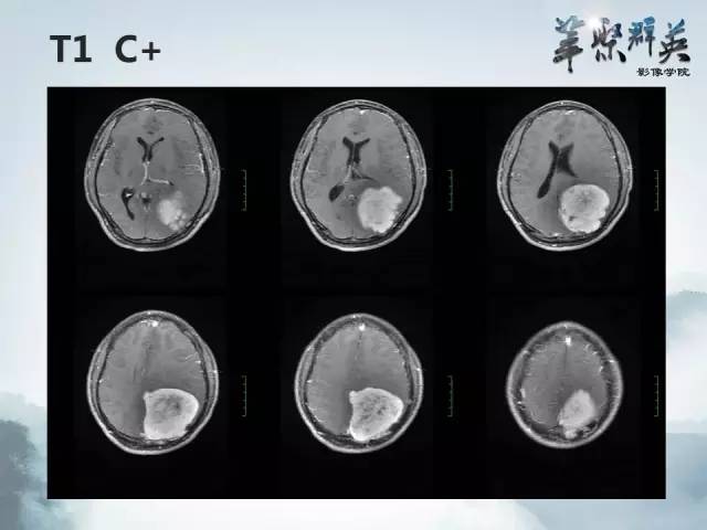 【病例】颅内孤立性纤维瘤1例MR影像表现与鉴别