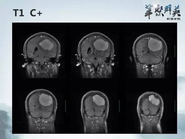 【病例】颅内孤立性纤维瘤1例MR影像表现与鉴别
