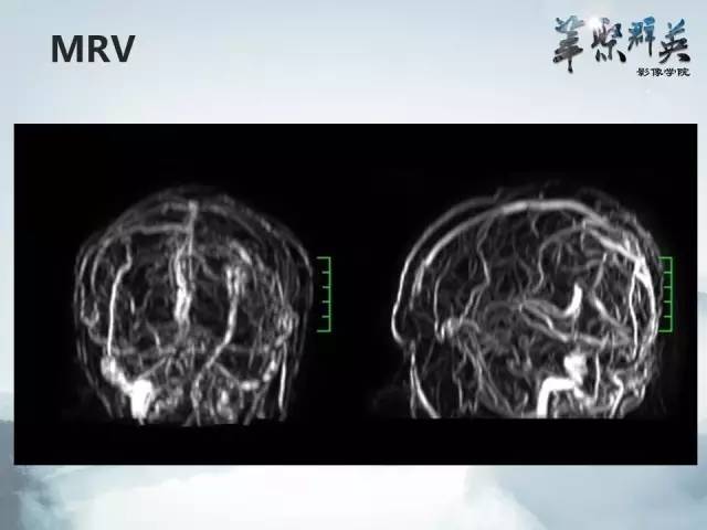 【病例】颅内孤立性纤维瘤1例MR影像表现与鉴别