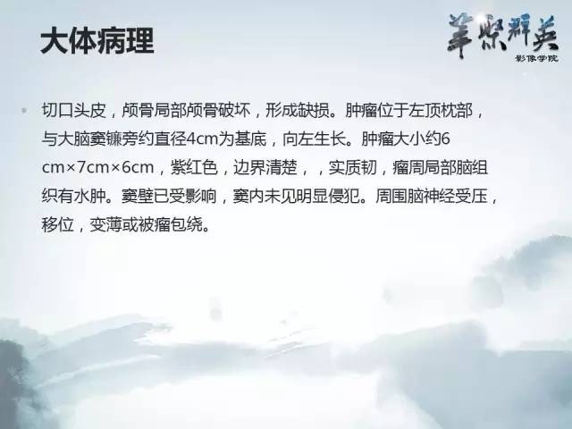 【病例】颅内孤立性纤维瘤1例MR影像表现与鉴别