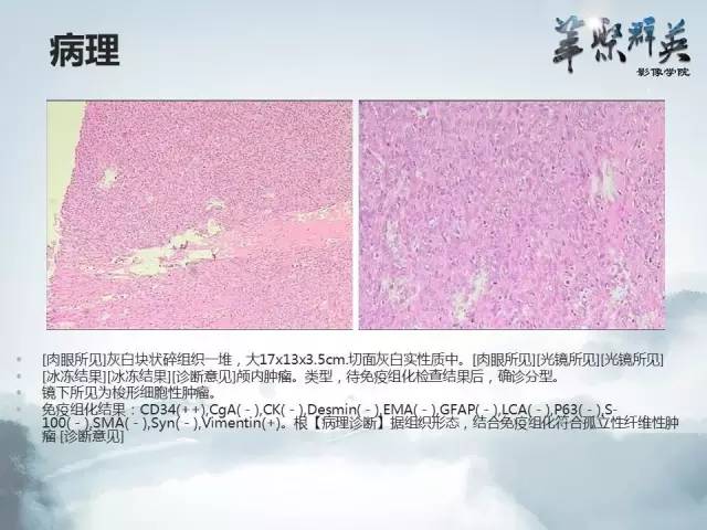 【病例】颅内孤立性纤维瘤1例MR影像表现与鉴别