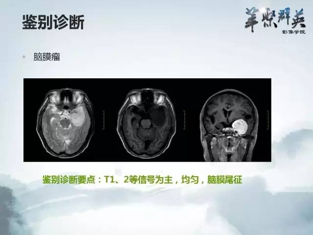 【病例】颅内孤立性纤维瘤1例MR影像表现与鉴别