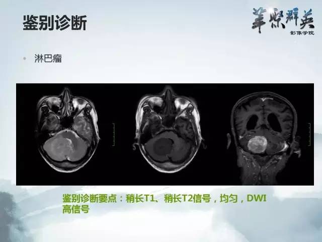 【病例】颅内孤立性纤维瘤1例MR影像表现与鉴别