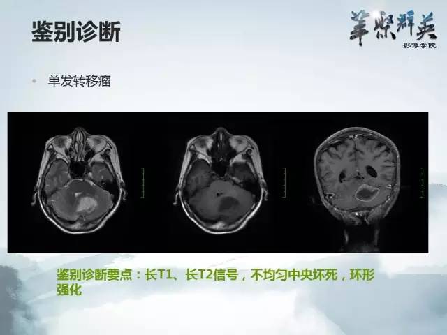 【病例】颅内孤立性纤维瘤1例MR影像表现与鉴别
