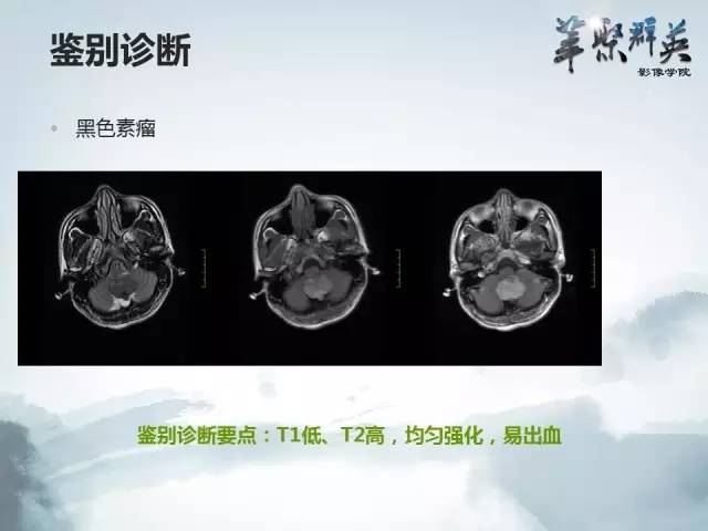【病例】颅内孤立性纤维瘤1例MR影像表现与鉴别