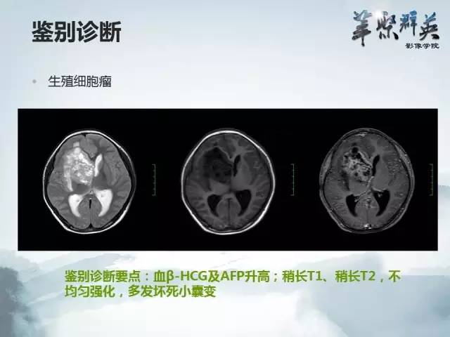【病例】颅内孤立性纤维瘤1例MR影像表现与鉴别