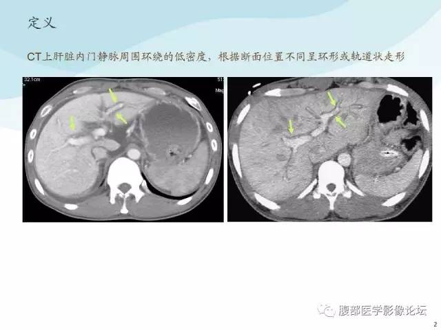 【PPT】门静脉周围低密度“晕征”或“轨道征”