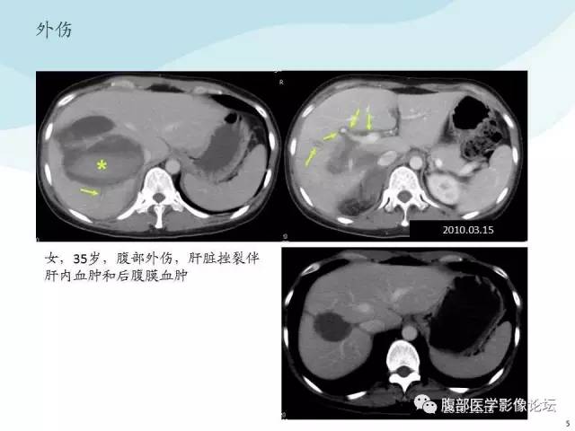 【PPT】门静脉周围低密度“晕征”或“轨道征”