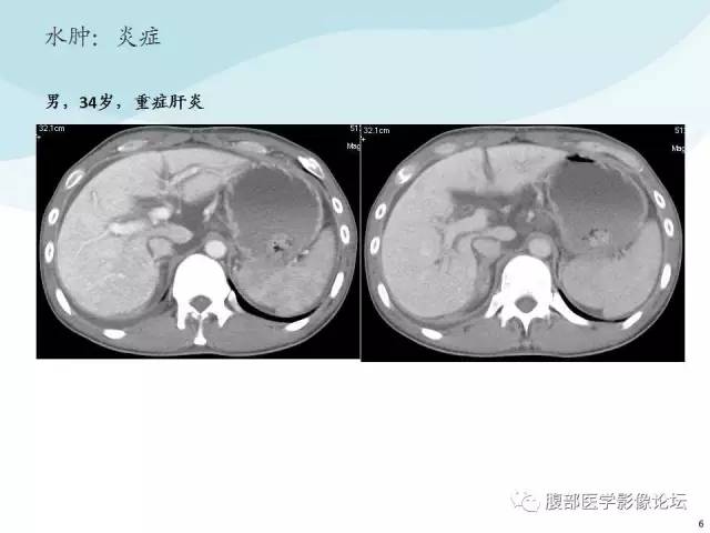 【PPT】门静脉周围低密度“晕征”或“轨道征”
