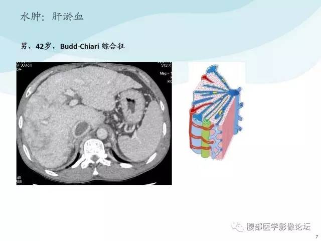 【PPT】门静脉周围低密度“晕征”或“轨道征”