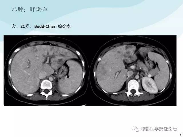 【PPT】门静脉周围低密度“晕征”或“轨道征”