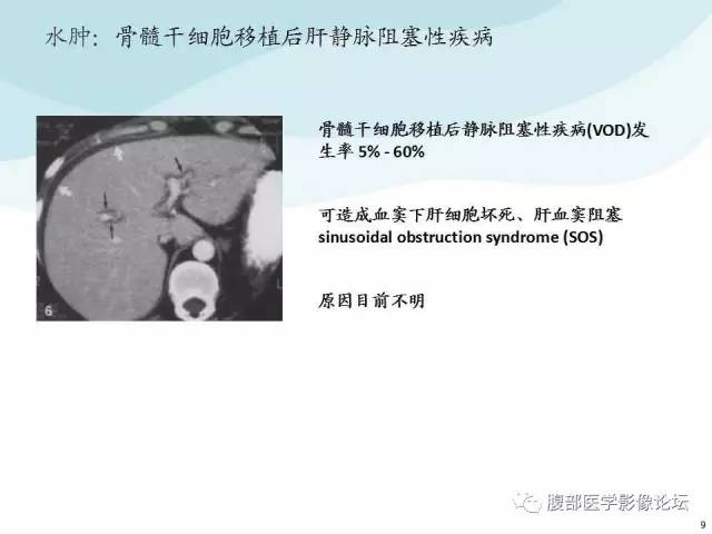 【PPT】门静脉周围低密度“晕征”或“轨道征”