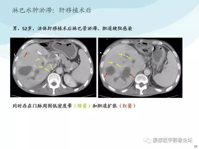 【PPT】门静脉周围低密度“晕征”或“轨道征”