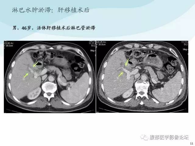 【PPT】门静脉周围低密度“晕征”或“轨道征”