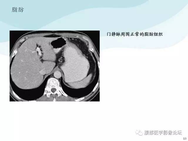【PPT】门静脉周围低密度“晕征”或“轨道征”