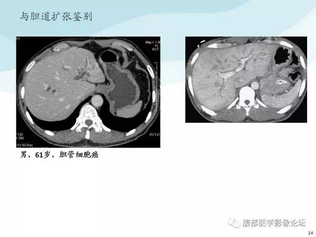 【PPT】门静脉周围低密度“晕征”或“轨道征”
