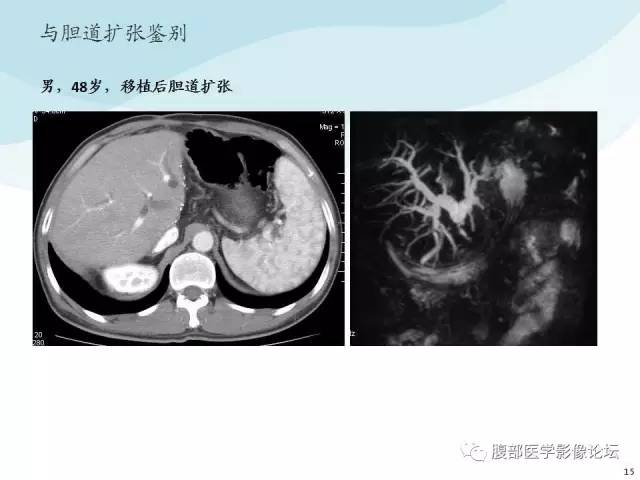 【PPT】门静脉周围低密度“晕征”或“轨道征”
