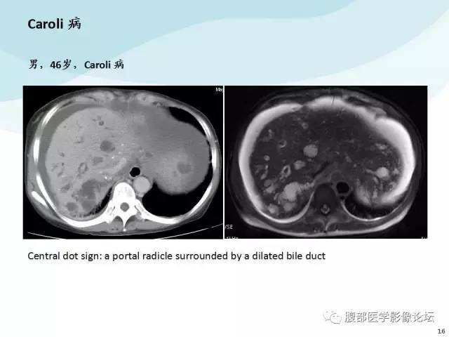 【PPT】门静脉周围低密度“晕征”或“轨道征”