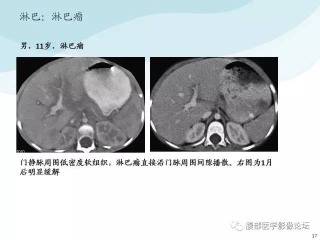 【PPT】门静脉周围低密度“晕征”或“轨道征”