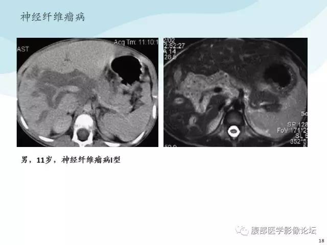 【PPT】门静脉周围低密度“晕征”或“轨道征”