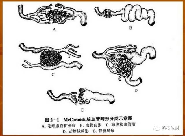 【病例】多发海绵状脑血管畸形1例CT及MR