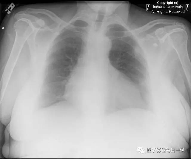 【病例】类风湿性关节炎继发心包积液1例X线CT 【病例】类风湿性关节炎继发心包积液1例X线CT