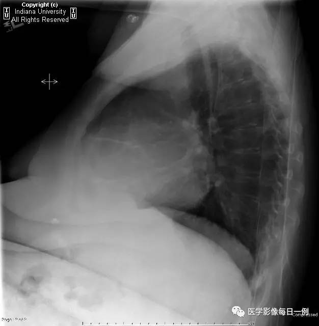 【病例】类风湿性关节炎继发心包积液1例X线CT 【病例】类风湿性关节炎继发心包积液1例X线CT