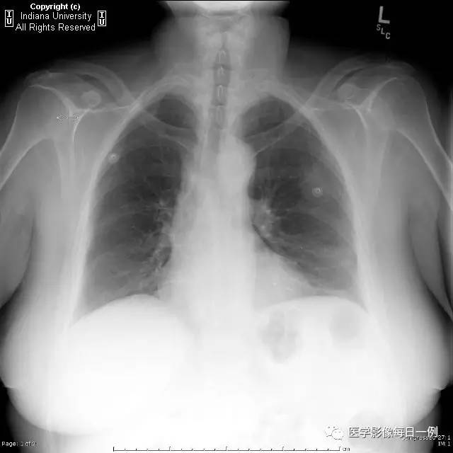 【病例】类风湿性关节炎继发心包积液1例X线CT 【病例】类风湿性关节炎继发心包积液1例X线CT