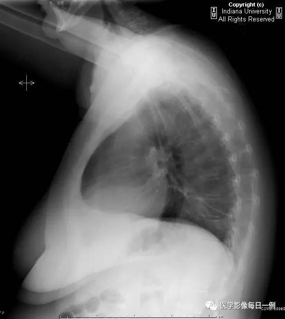 【病例】类风湿性关节炎继发心包积液1例X线CT 【病例】类风湿性关节炎继发心包积液1例X线CT