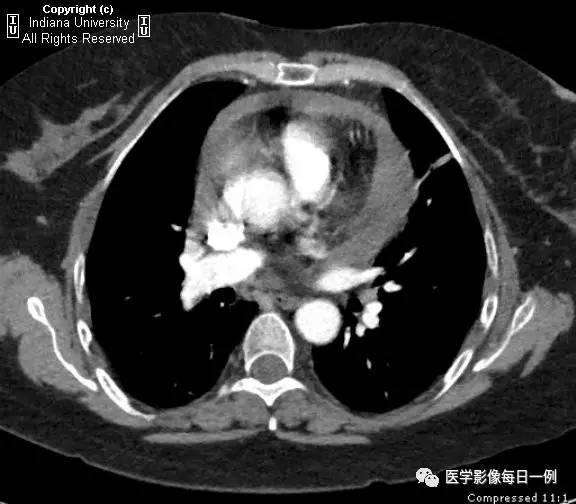 【病例】类风湿性关节炎继发心包积液1例X线CT 【病例】类风湿性关节炎继发心包积液1例X线CT