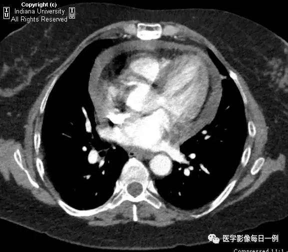 【病例】类风湿性关节炎继发心包积液1例X线CT 【病例】类风湿性关节炎继发心包积液1例X线CT