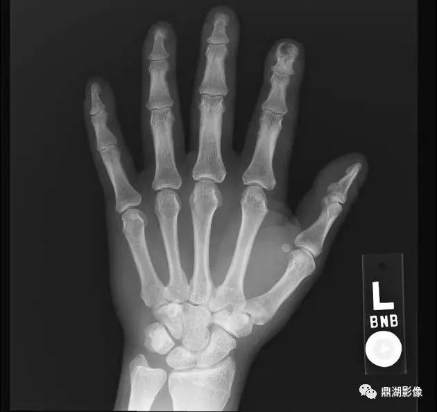 手足骨常见疾病的鉴别诊断
